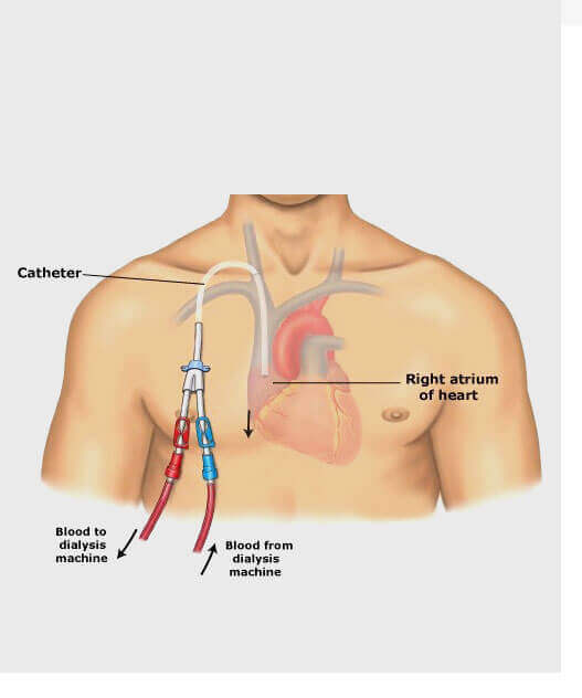 Dialysis catheter