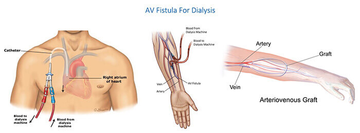 Фистула. Артериовенозный фистула. Нативная артерио-венозная фистула. Артериовенозная фистула диализ.