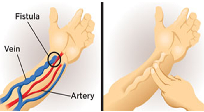 about_fistula_surgery.jpg