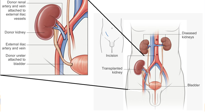 basic_information_on_kidney_transplant.jpg