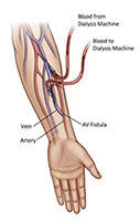 A V Fistula