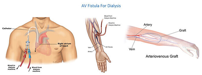 Comparison between dialysis catheter, fistula and graft